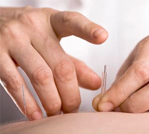 Acupuncture